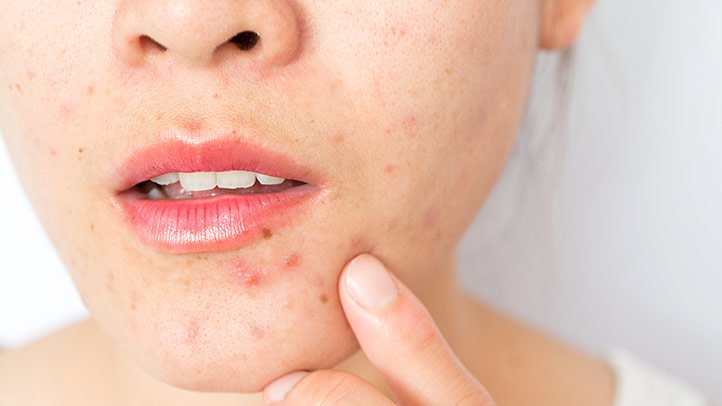 Foods which cause Acne Problems